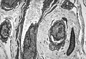F,48y. | reduplication of endothelial basement membranes - skin - susp. lupus erythematodes F,48y. | reduplication of endothelial basement membranes - skin - susp. lupus erythematodes